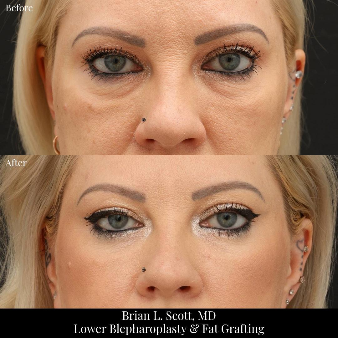 NewSkin MedSpa & Plastic Surgery eyelid lift result — Bellevue, WA