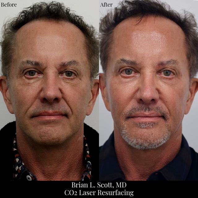 Laser Skin Resurfacing result at NewSkin MedSpa & Plastic Surgery in Bellevue, WA