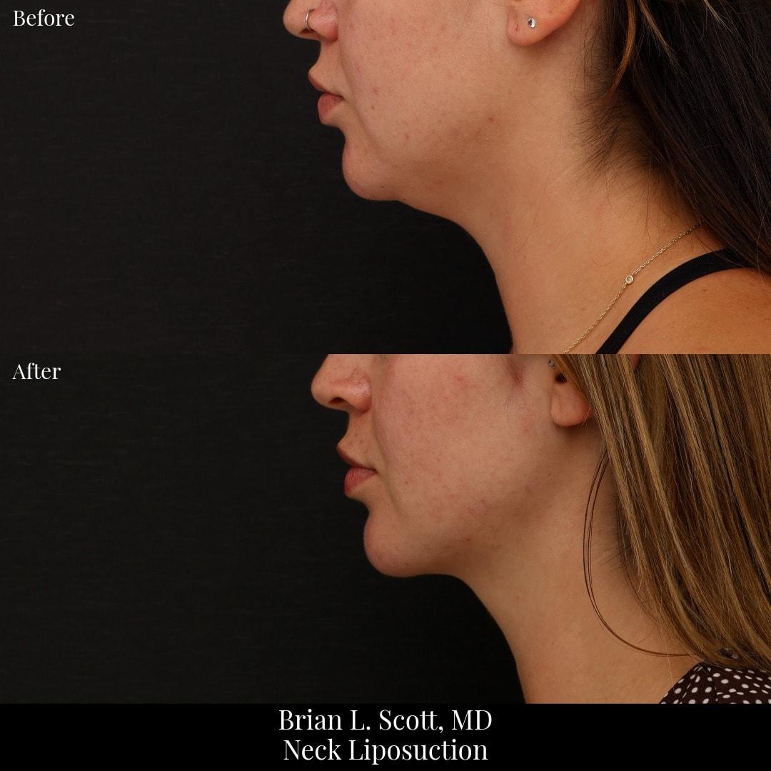NewSkin MedSpa & Plastic Surgery neck liposuction result — Bellevue, WA
