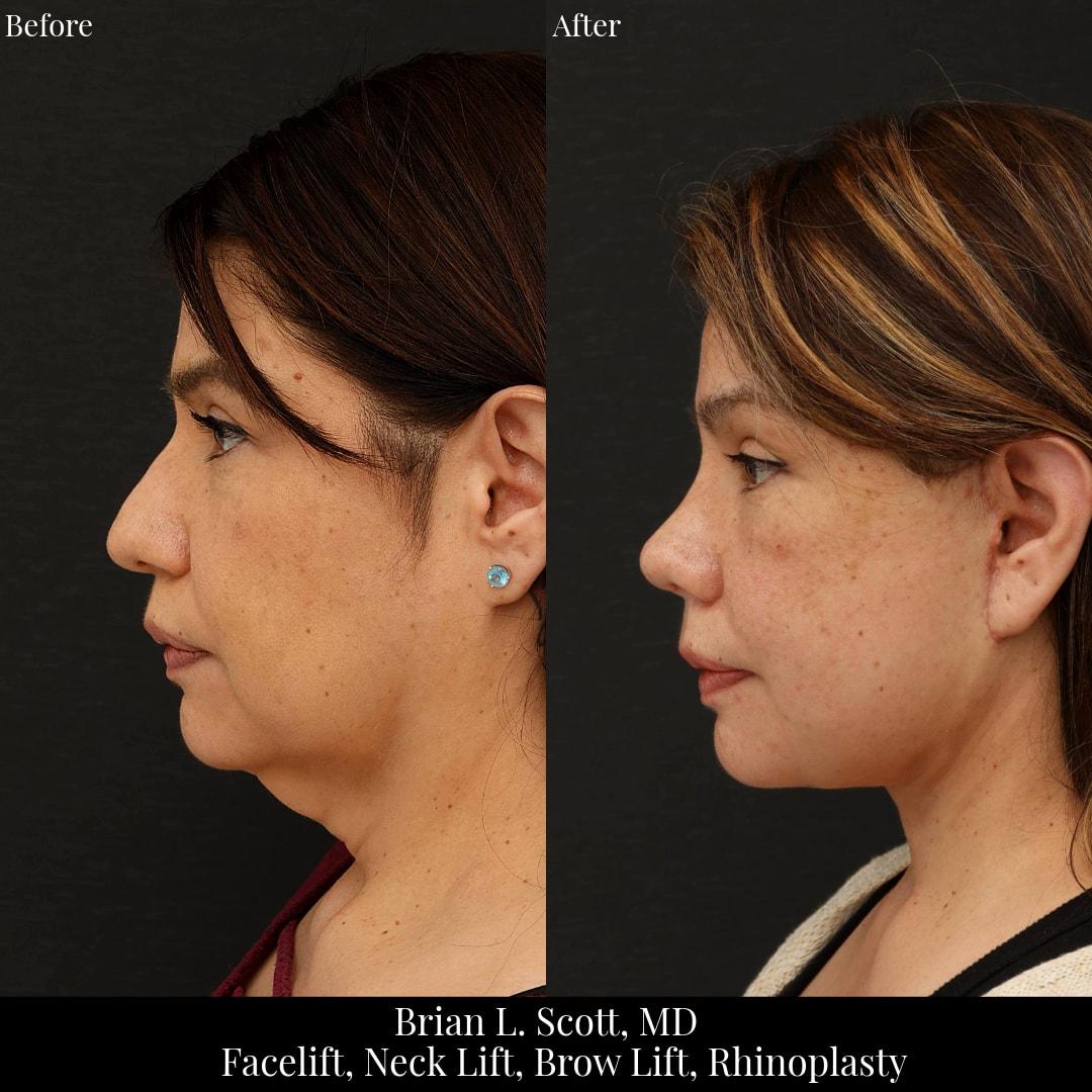NewSkin MedSpa & Plastic Surgery facelift result — Bellevue, WA