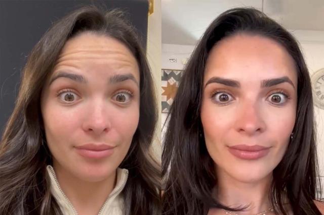 Botox result at NewSkin MedSpa & Plastic Surgery in Bellevue, WA
