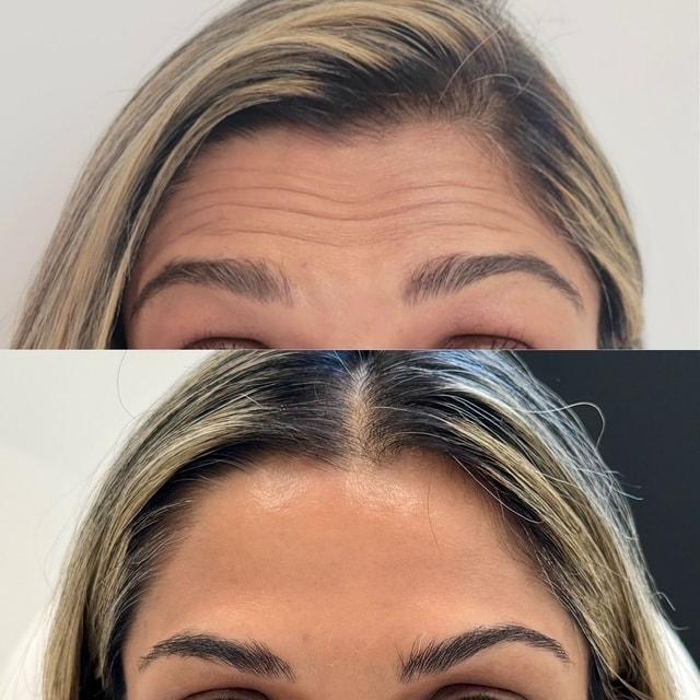 Botox result at NewSkin MedSpa & Plastic Surgery in Bellevue, WA