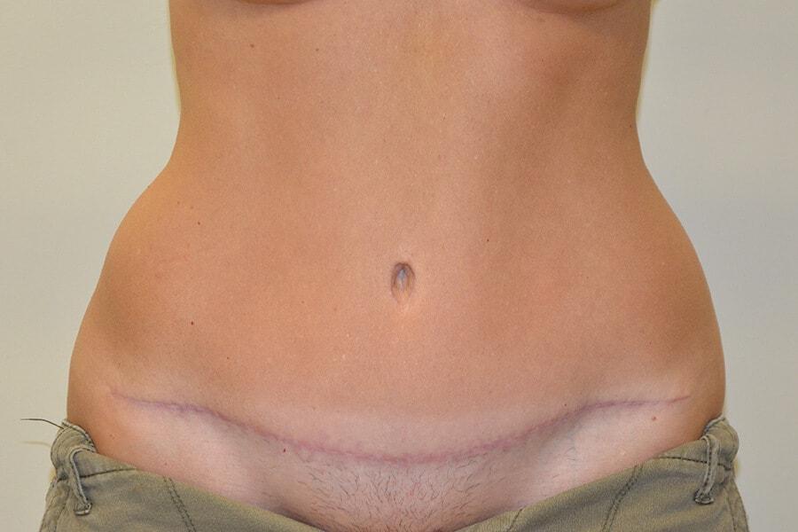 Allen Doezie, MD tummy tuck after — Ladera Ranch, CA