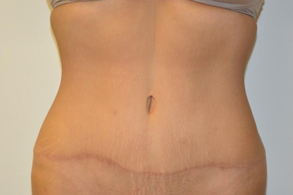 Allen Doezie, MD tummy tuck after — Ladera Ranch, CA