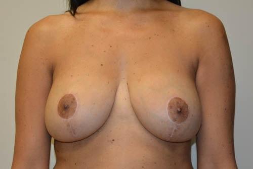 Allen Doezie, MD breast lift after — Ladera Ranch, CA