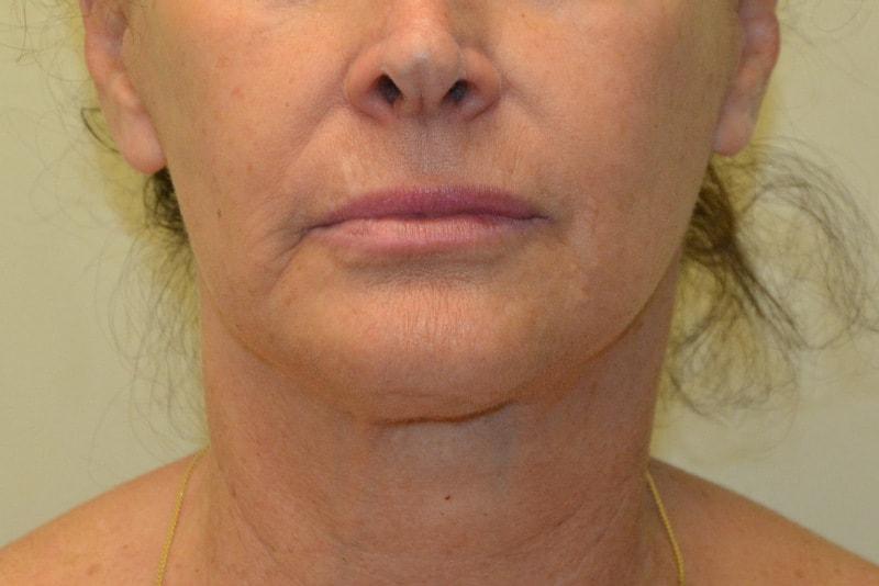 Allen Doezie, MD facelift after — Ladera Ranch, CA