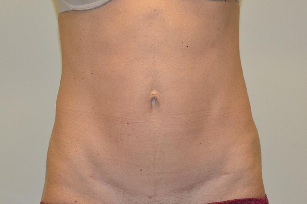 Allen Doezie, MD tummy tuck after — Ladera Ranch, CA