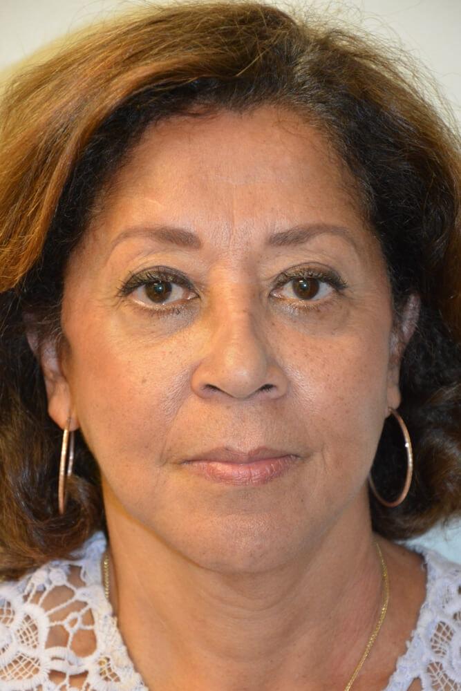 Allen Doezie, MD facelift after — Ladera Ranch, CA