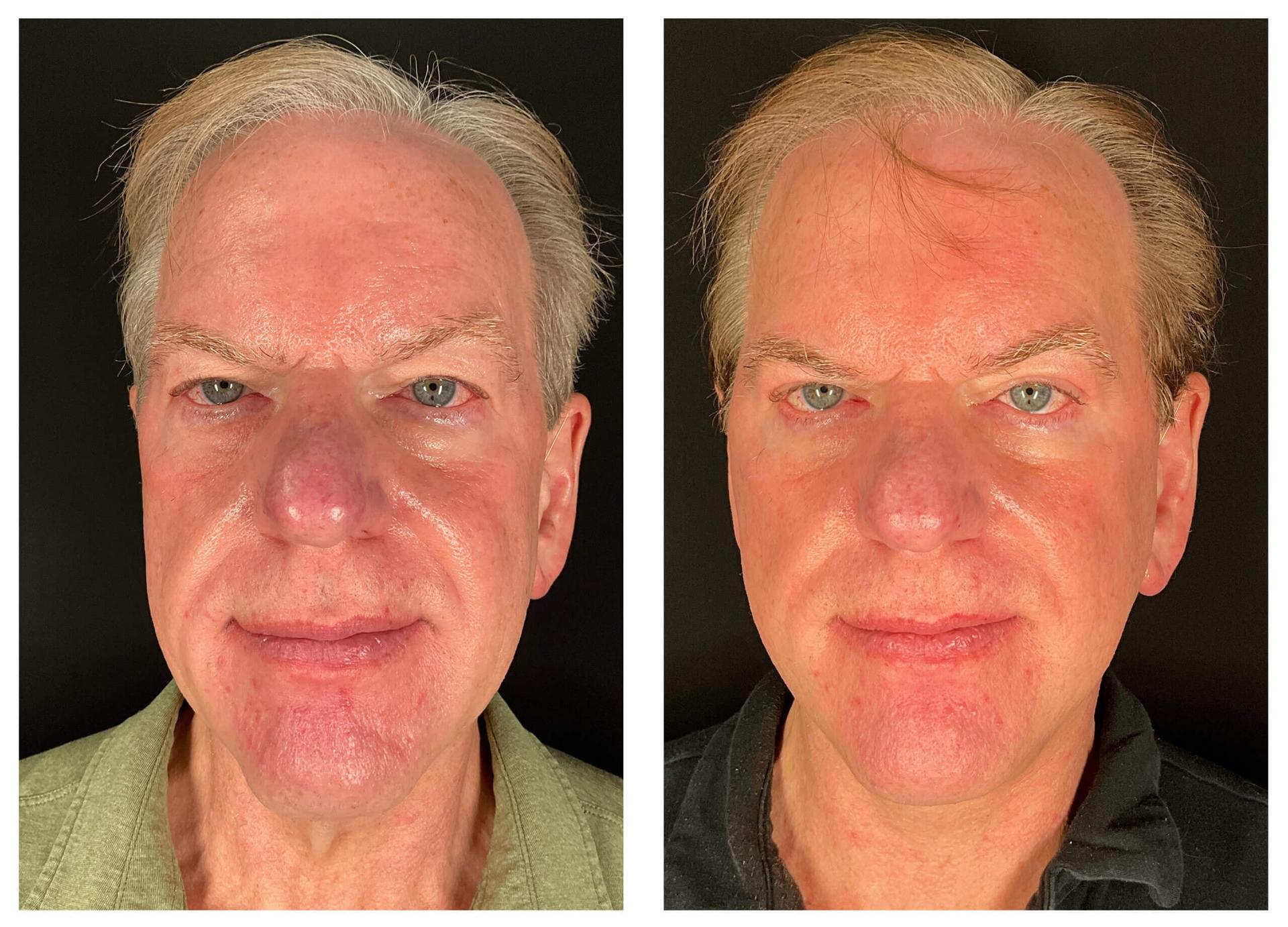 Gaon Plastic Surgery facelift result — Newport Beach, CA