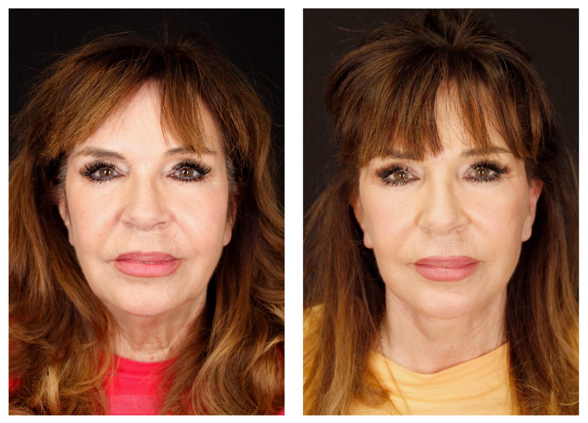 Gaon Plastic Surgery facelift result — Newport Beach, CA