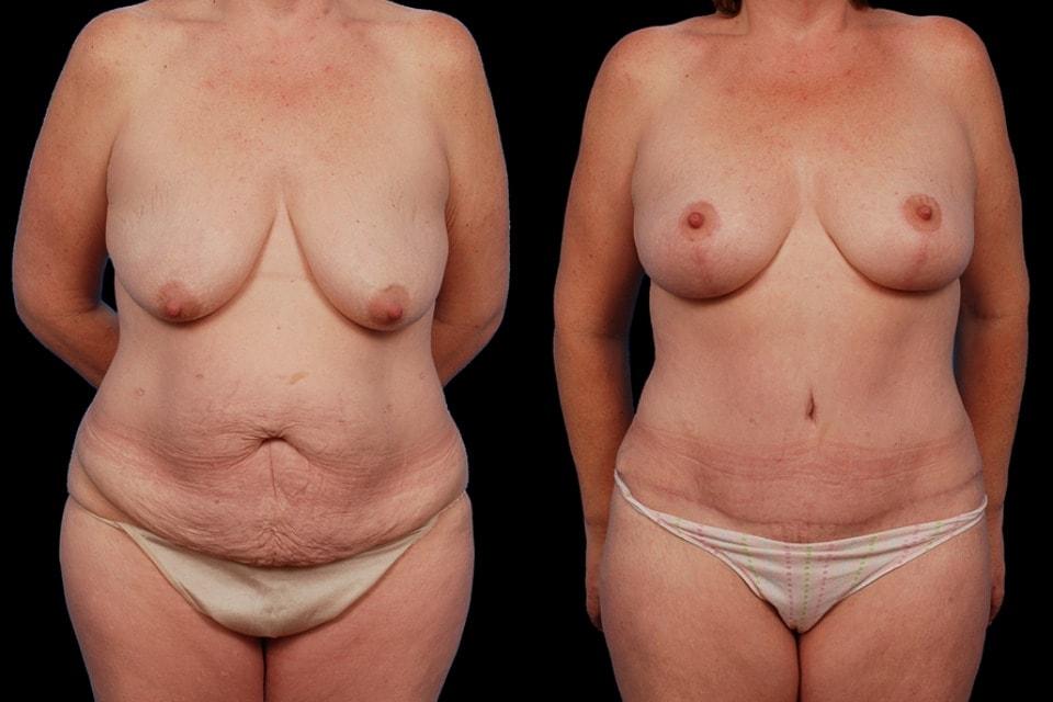 Gaon Plastic Surgery mommy makeover result — Newport Beach, CA