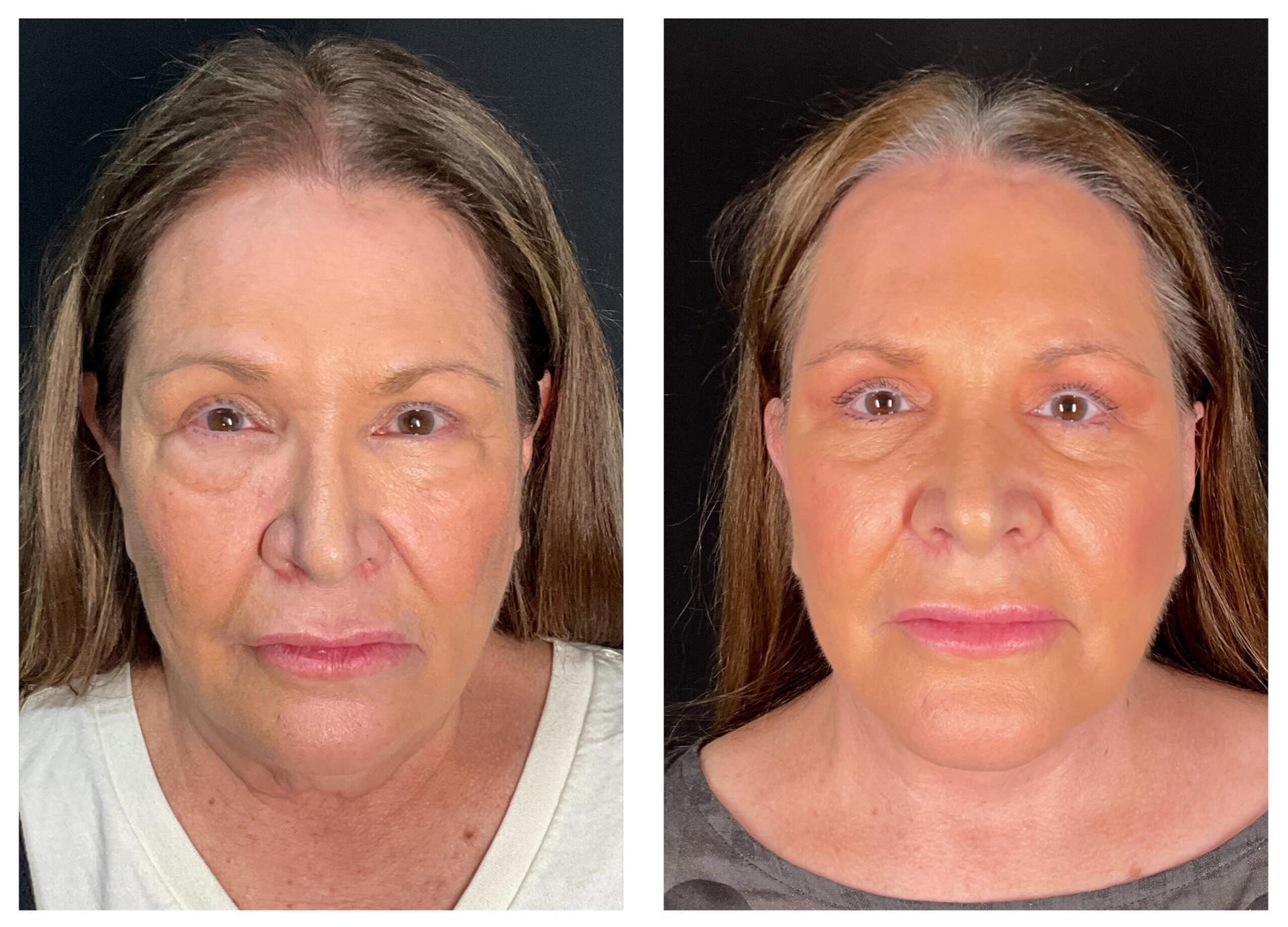 Gaon Plastic Surgery facelift result — Newport Beach, CA