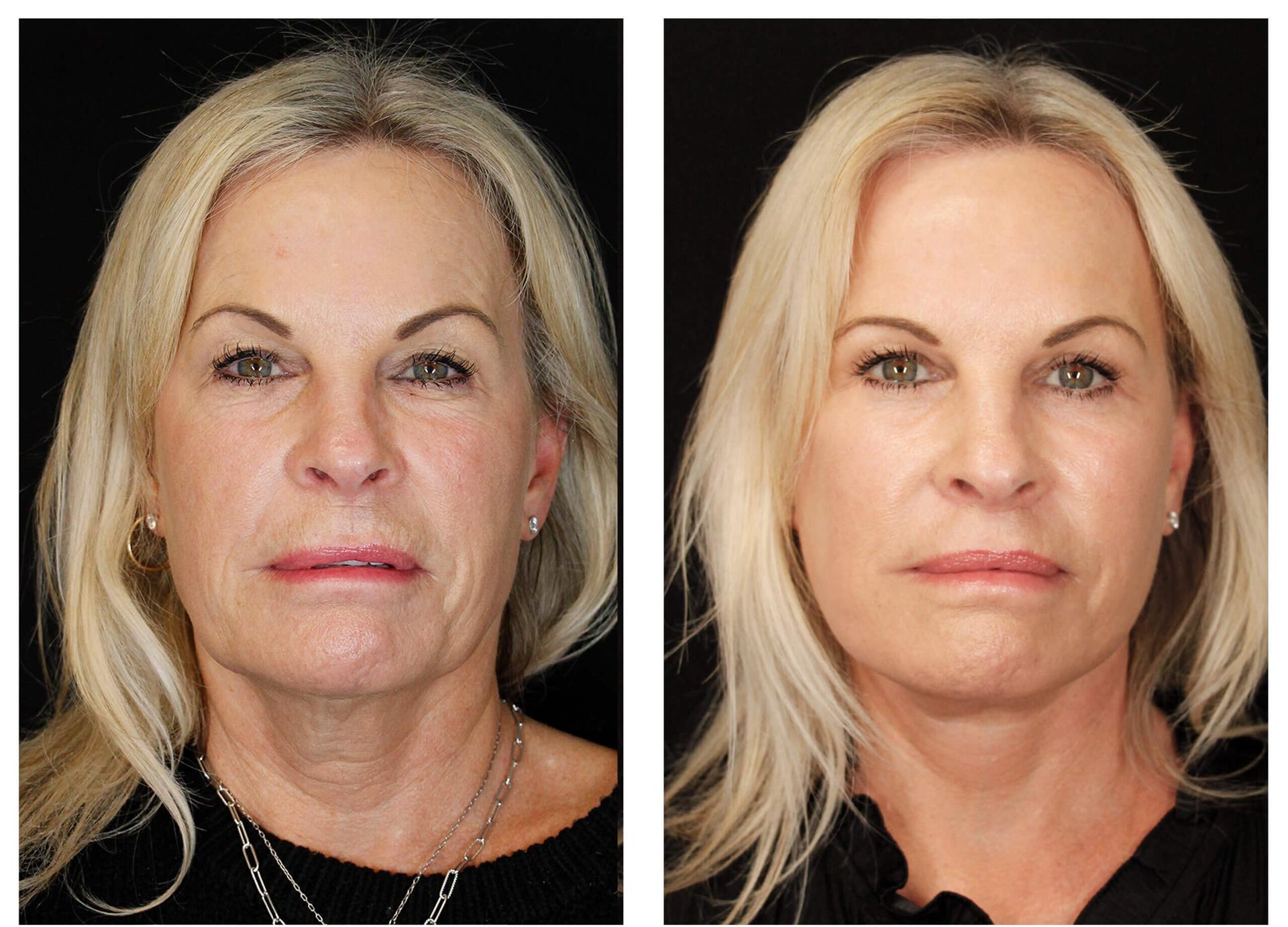 Gaon Plastic Surgery facelift result — Newport Beach, CA