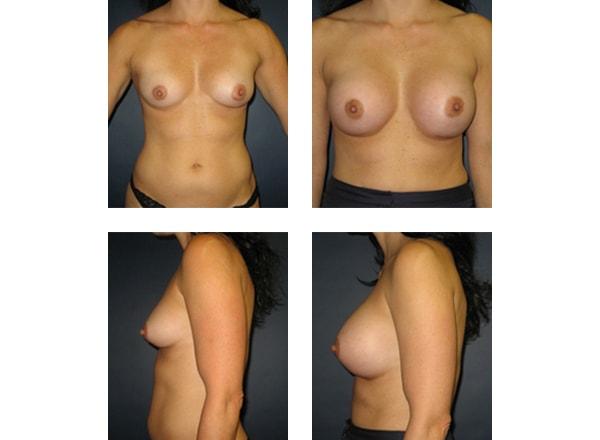 Schulman Plastic Surgery (Matthew Schulman, MD) breast augmentation result — New York, NY