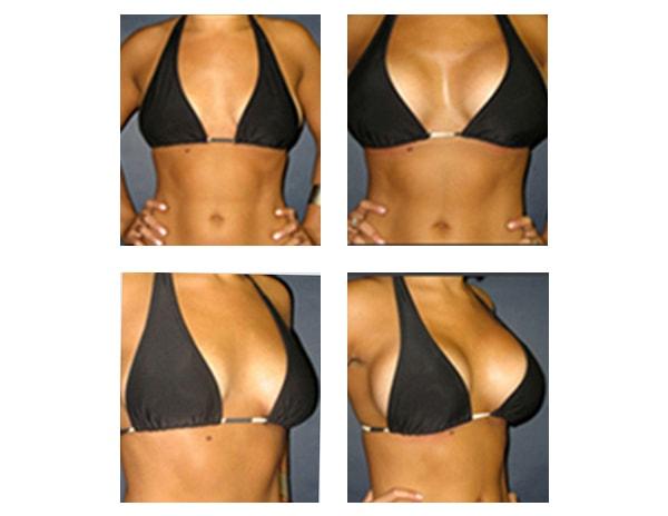 Schulman Plastic Surgery (Matthew Schulman, MD) breast augmentation result — New York, NY