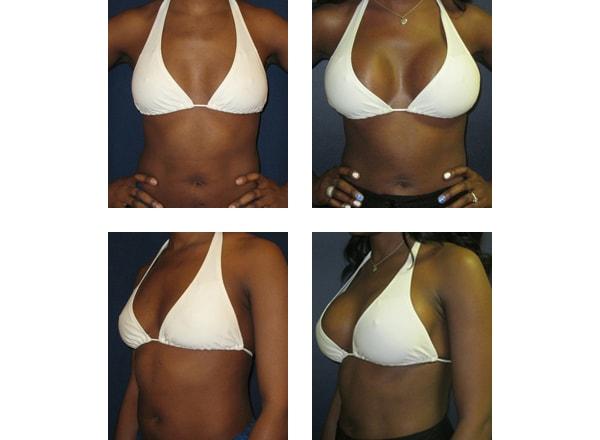 Schulman Plastic Surgery (Matthew Schulman, MD) breast augmentation result — New York, NY