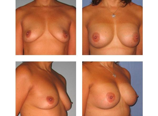 Schulman Plastic Surgery (Matthew Schulman, MD) breast augmentation result — New York, NY