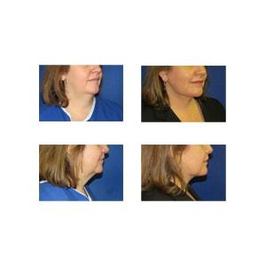 Schulman Plastic Surgery (Matthew Schulman, MD) neck lift result — New York, NY