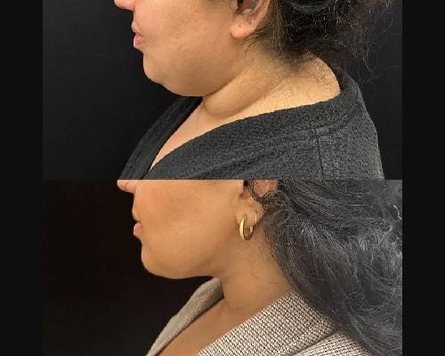 Mansher Singh, MD, FACS neck liposuction result — New York, NY