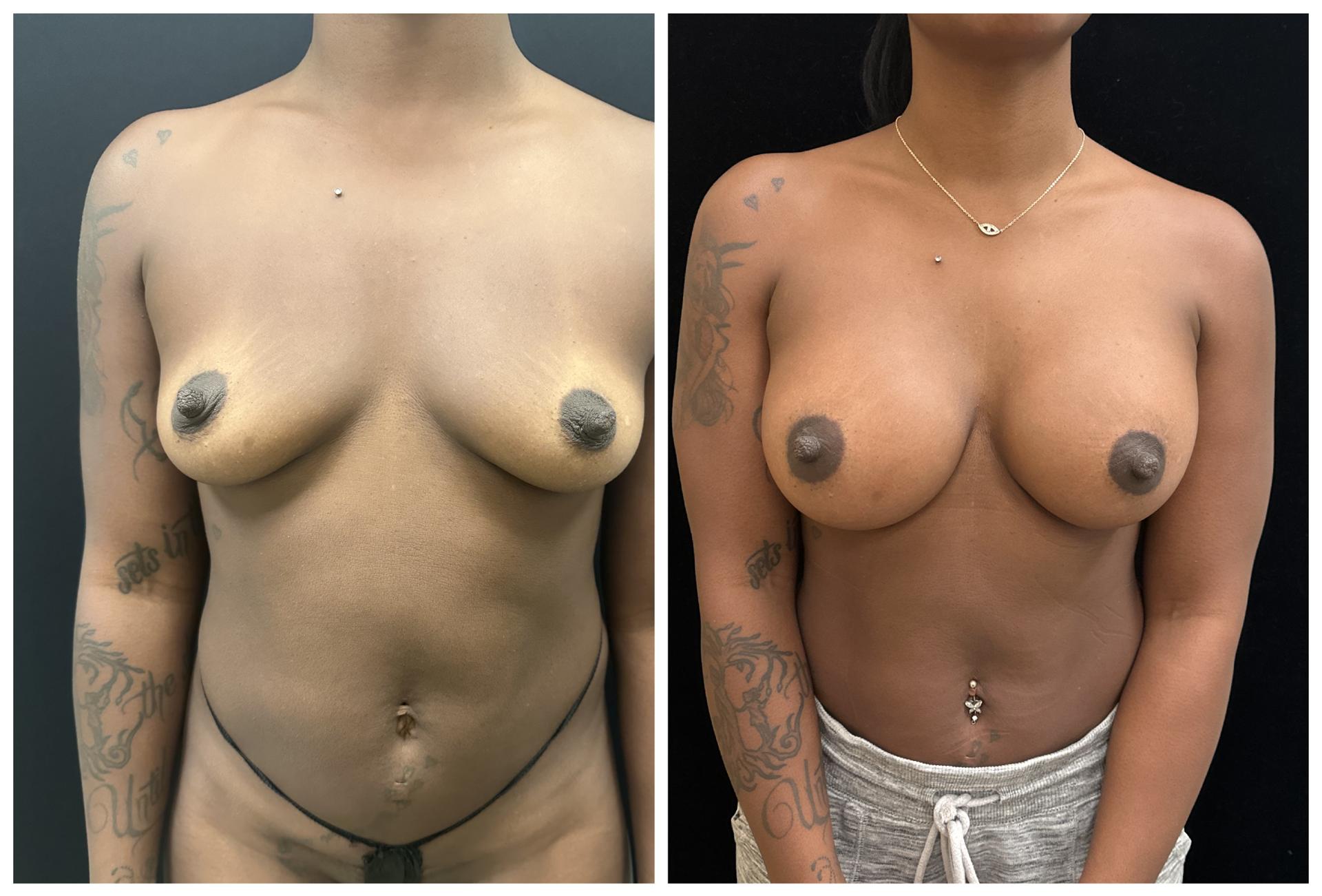 Mansher Singh, MD, FACS breast augmentation result — New York, NY