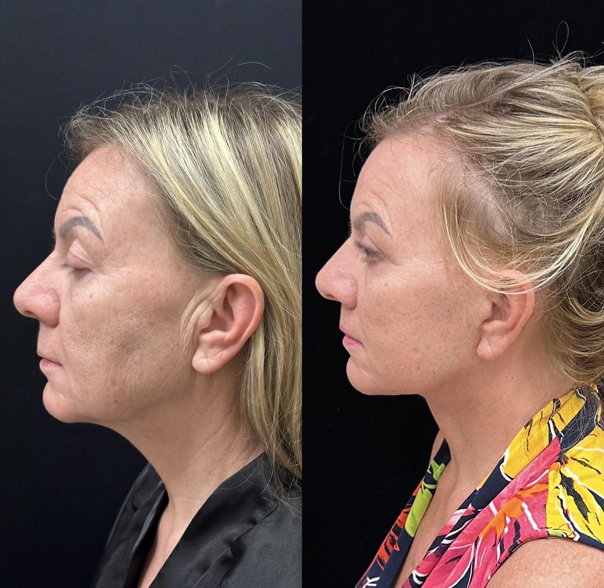 Mansher Singh, MD, FACS lip lift result — New York, NY