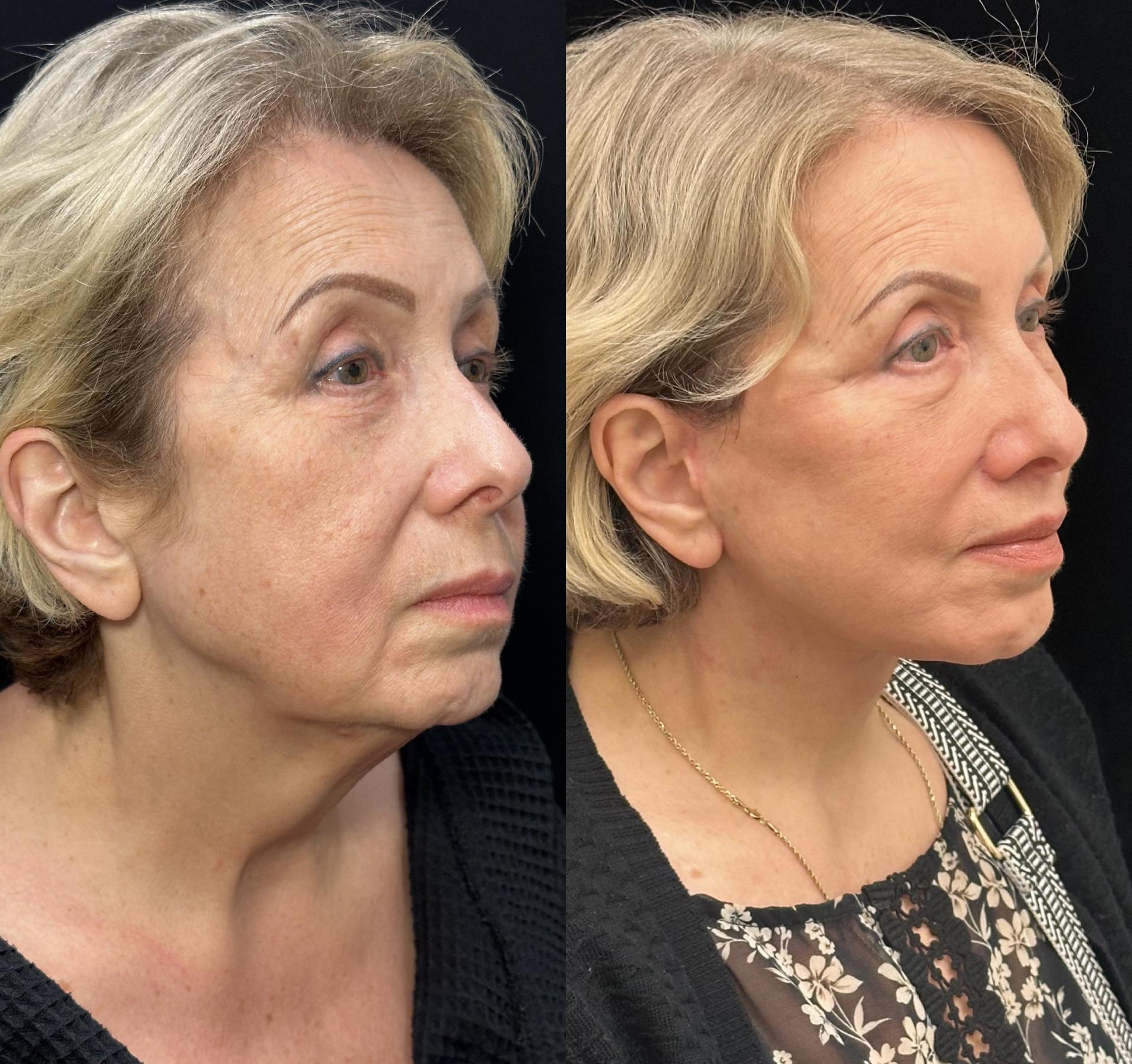 Mansher Singh, MD, FACS neck lift result — New York, NY