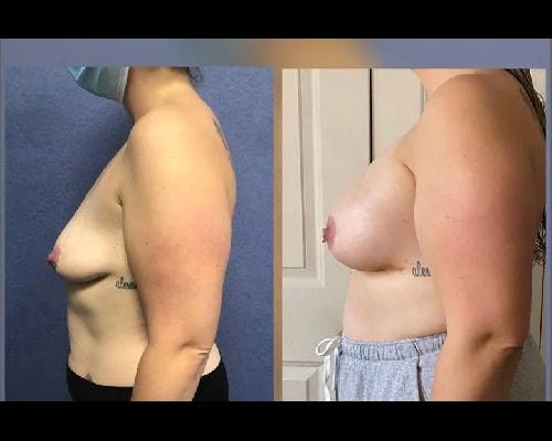 Mansher Singh, MD, FACS breast augmentation result — New York, NY