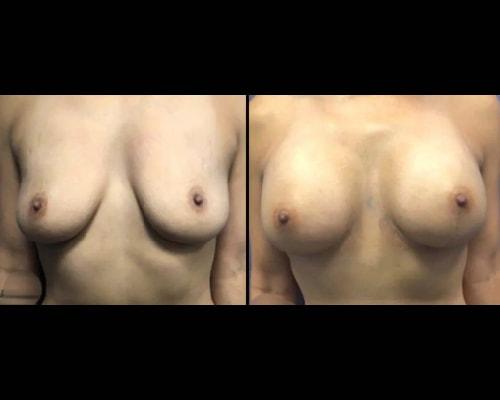 Mansher Singh, MD, FACS breast augmentation result — New York, NY