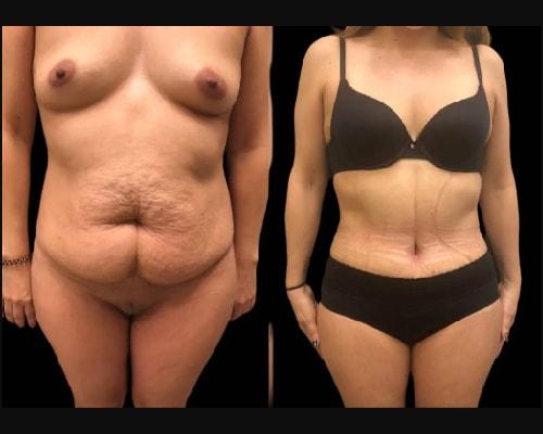Mansher Singh, MD, FACS tummy tuck result — New York, NY