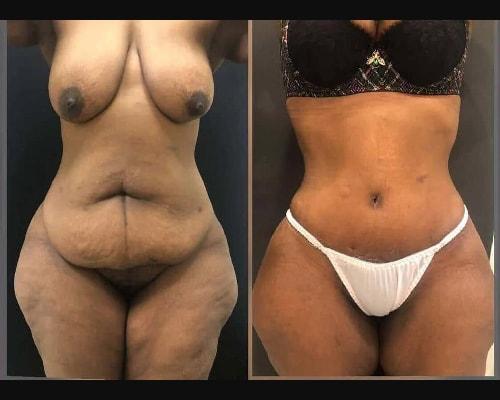 Mansher Singh, MD, FACS tummy tuck result — New York, NY