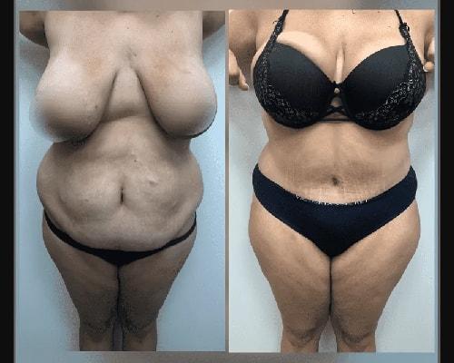 Mansher Singh, MD, FACS tummy tuck result — New York, NY