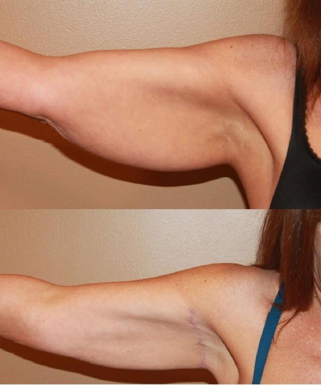Arm Lift result at Palmer Cosmetic Surgery in Fort Lauderdale, FL