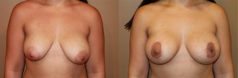 Palmer Cosmetic Surgery breast lift result — Fort Lauderdale, FL