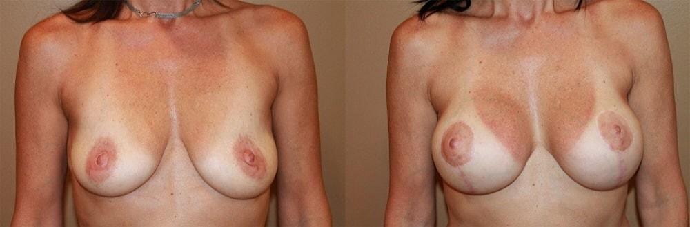 Palmer Cosmetic Surgery breast lift result — Fort Lauderdale, FL