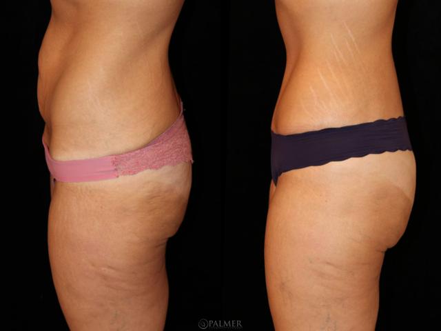 Arm Lift result at Palmer Cosmetic Surgery in Fort Lauderdale, FL
