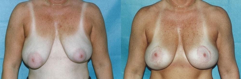 Palmer Cosmetic Surgery breast lift result — Fort Lauderdale, FL