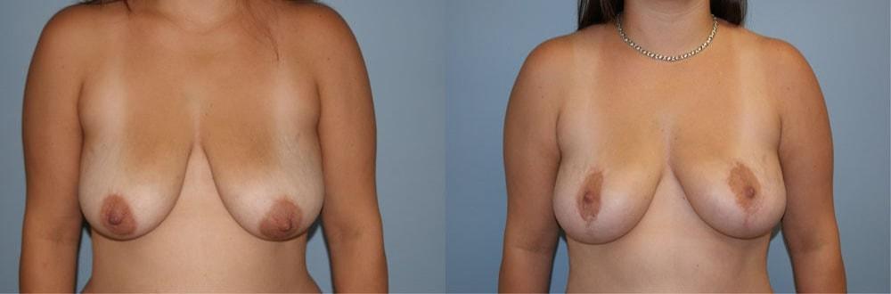 Palmer Cosmetic Surgery breast lift result — Fort Lauderdale, FL