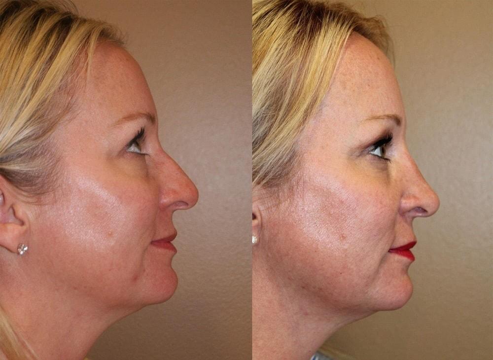 Palmer Cosmetic Surgery rhinoplasty result — Fort Lauderdale, FL