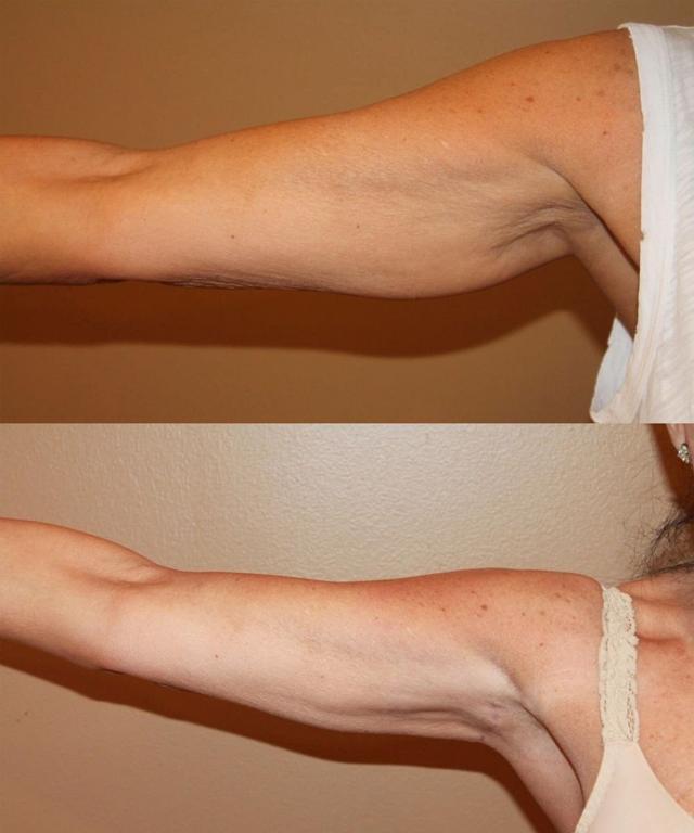 Arm Lift result at Palmer Cosmetic Surgery in Fort Lauderdale, FL