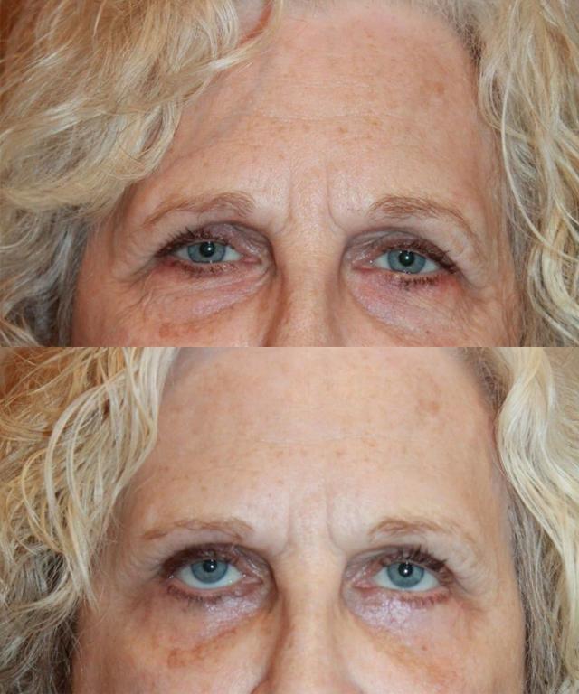 Brow Lift result at Palmer Cosmetic Surgery in Fort Lauderdale, FL