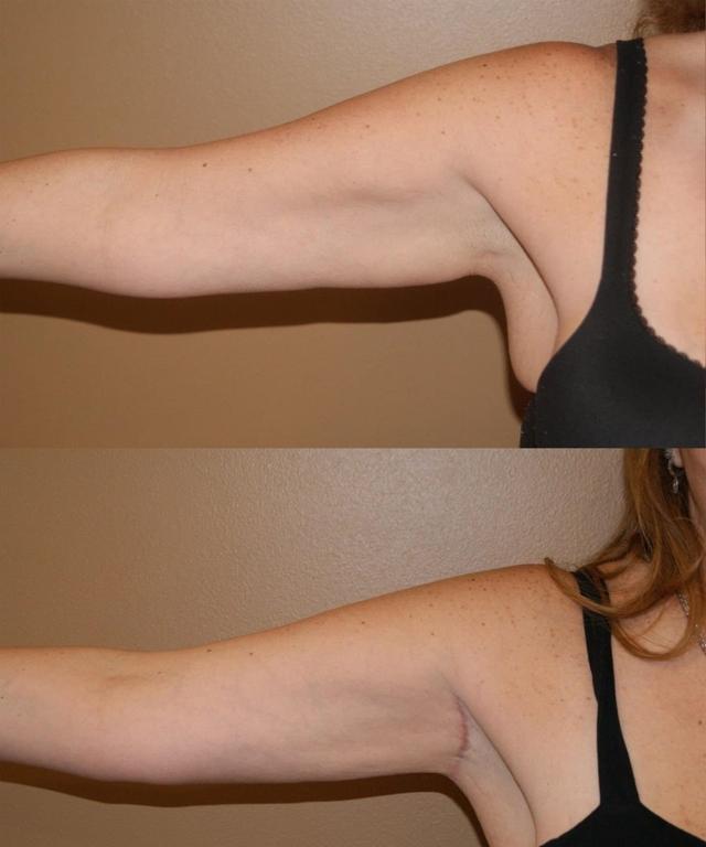 Arm Lift result at Palmer Cosmetic Surgery in Fort Lauderdale, FL