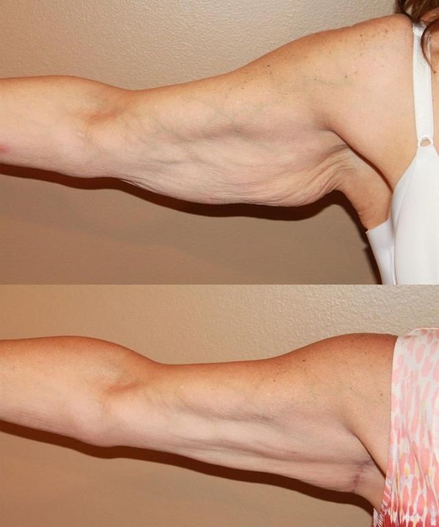 Arm Lift result at Palmer Cosmetic Surgery in Fort Lauderdale, FL