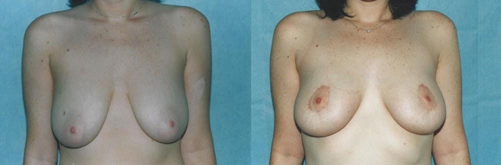 Palmer Cosmetic Surgery breast lift result — Fort Lauderdale, FL
