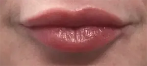 Lip Filler after at Nurse Christine Yanikian, Aspire aesthetics | Botox and Filler Injector in Costa Mesa in Costa Mesa, CA