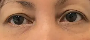 Nurse Christine Yanikian, Aspire aesthetics | Botox and Filler Injector in Costa Mesa after — Costa Mesa, CA