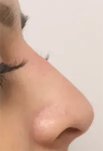 Nurse Christine Yanikian, Aspire aesthetics | Botox and Filler Injector in Costa Mesa after — Costa Mesa, CA