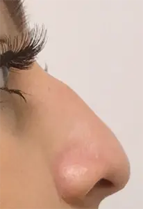 Functional Rhinoplasty before at Nurse Christine Yanikian, Aspire aesthetics | Botox and Filler Injector in Costa Mesa in Costa Mesa, CA