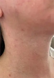 Nurse Christine Yanikian, Aspire aesthetics | Botox and Filler Injector in Costa Mesa after — Costa Mesa, CA