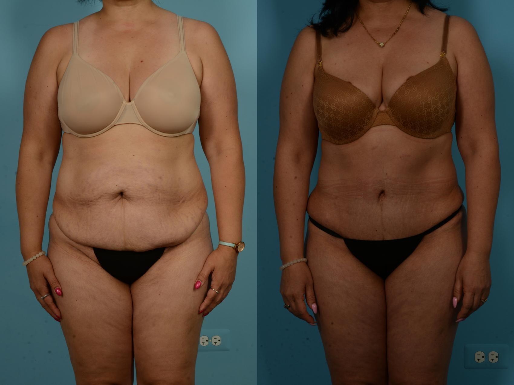 TLKM Plastic Surgery (Sammy Sinno, MD) tummy tuck result — Chicago, IL