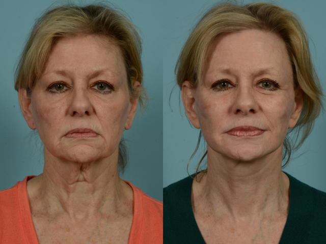 Neck Lift result at TLKM Plastic Surgery (Sammy Sinno, MD) in Chicago, IL